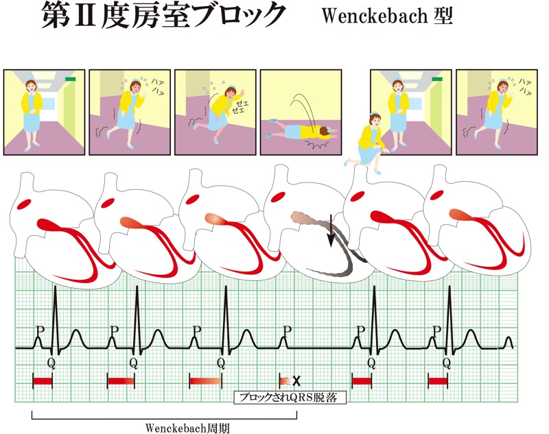 Wenckebach型第2度房室ブロック